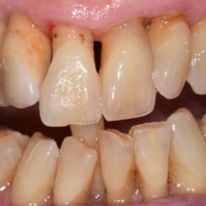 cos'è la parodontite, perdita dei denti